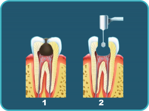 Пульпит: как происходит лечение?